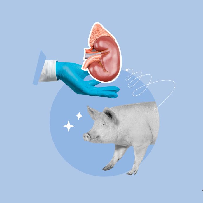 kidney transplant pig, kidney, pig, transplant, experimentation, pig to human, science, doctors, doctor with kidney, hand, technological advancement, chronic kidney disease, treatment, urinary system