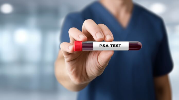 Medical professional holding PSA blood sample vial PSA - Prostata