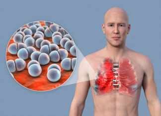 Pneumococco sotto la lente: come difendersi da un nemico silenzioso Pneumococco