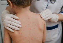 Varicella e dintorni.