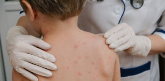 Varicella e dintorni.