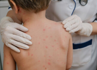 Varicella e dintorni.
